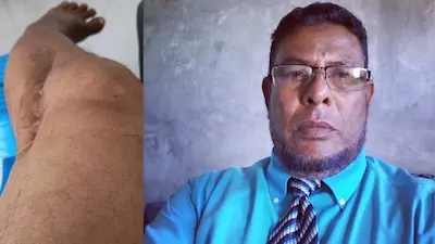 ބުޝްރީ: ނޮވެމްބަރު 3ގައި ގަޔަށްއެރި ވަޒަނުން ލިބުނު އަނިޔާއަށް އެދެވޭ ފަރުވާ ނުލިބި 36އަހަރު, މާދަންވެސް ފައިބުރިކޮށްލަން ޖެހިދާނެ!