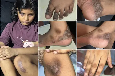 އެކްޒީމާގެ ސަބަބުން ކުޑަކުޑަ ސާރާގެ މުޅިހަށިގަނޑު ހަލާކުވެ، އެހާމެ ވޭނުގައި، ސުކޫލަށްވެސް ނުދެވޭ؛ ބޭނުންވަނީ ދީލަތި އެހީ!